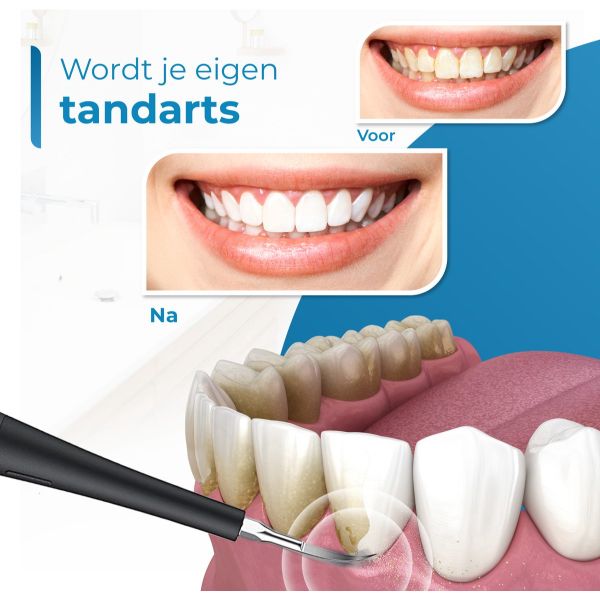 SonicBright™ – Vgood – Sonische kracht voor een wittere glimlach