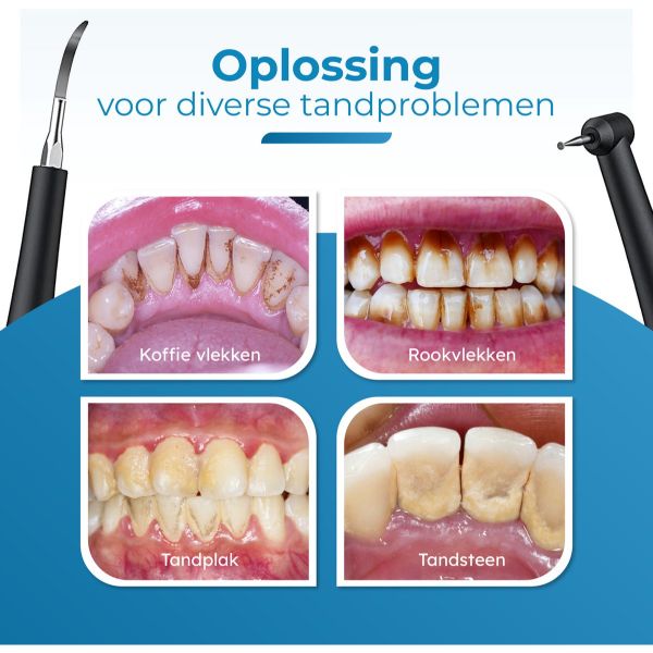 SonicBright™ – Vgood – Sonische kracht voor een wittere glimlach